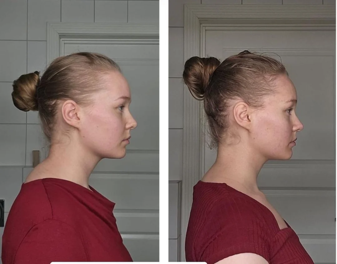 Before and after side profile showing neck posture difference